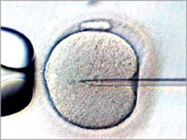 Инжектиране на един сперматозоид директно в цитоплазмата на яйцеклетката, чрез микроинжекционна пипета под пълно микроскопско наблюдение.
